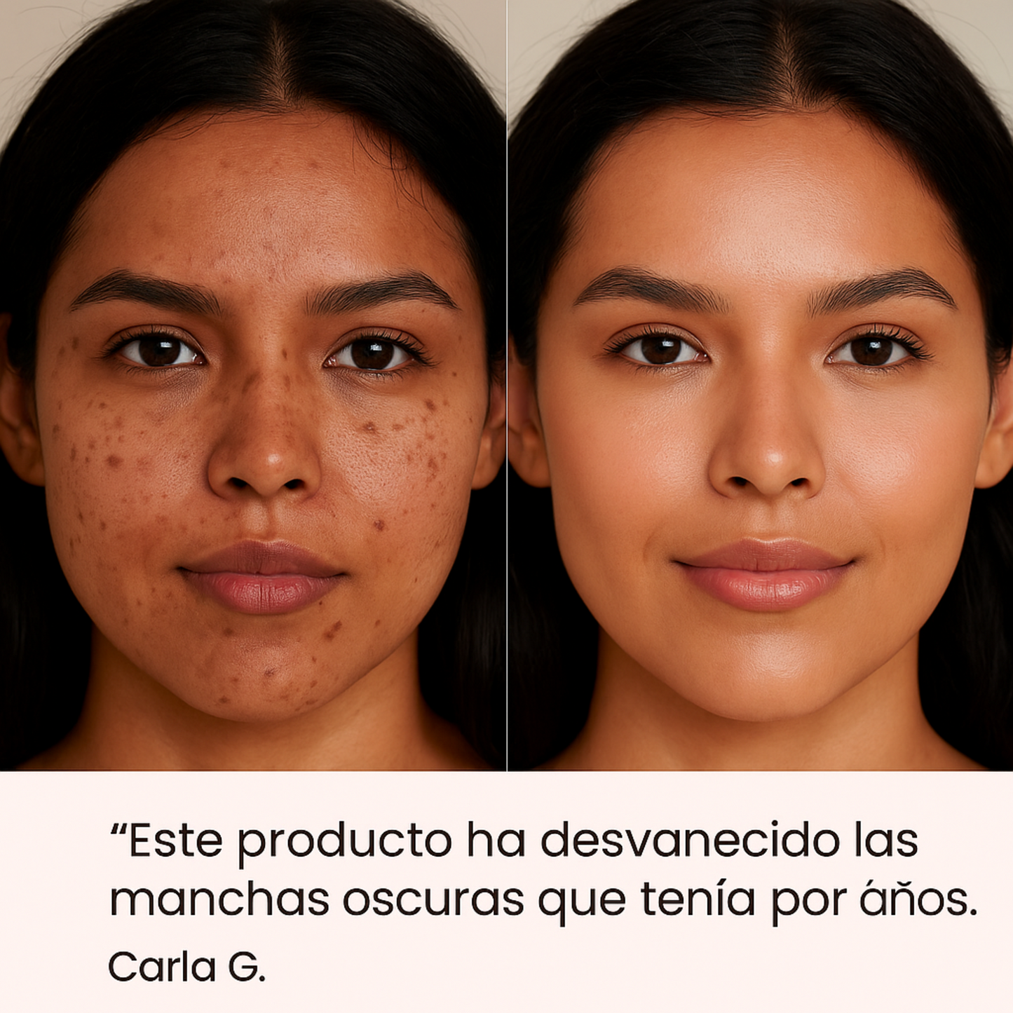 Piel libre de acné, manchas y sebo en 14 días con el Serum Coreano de ANUA